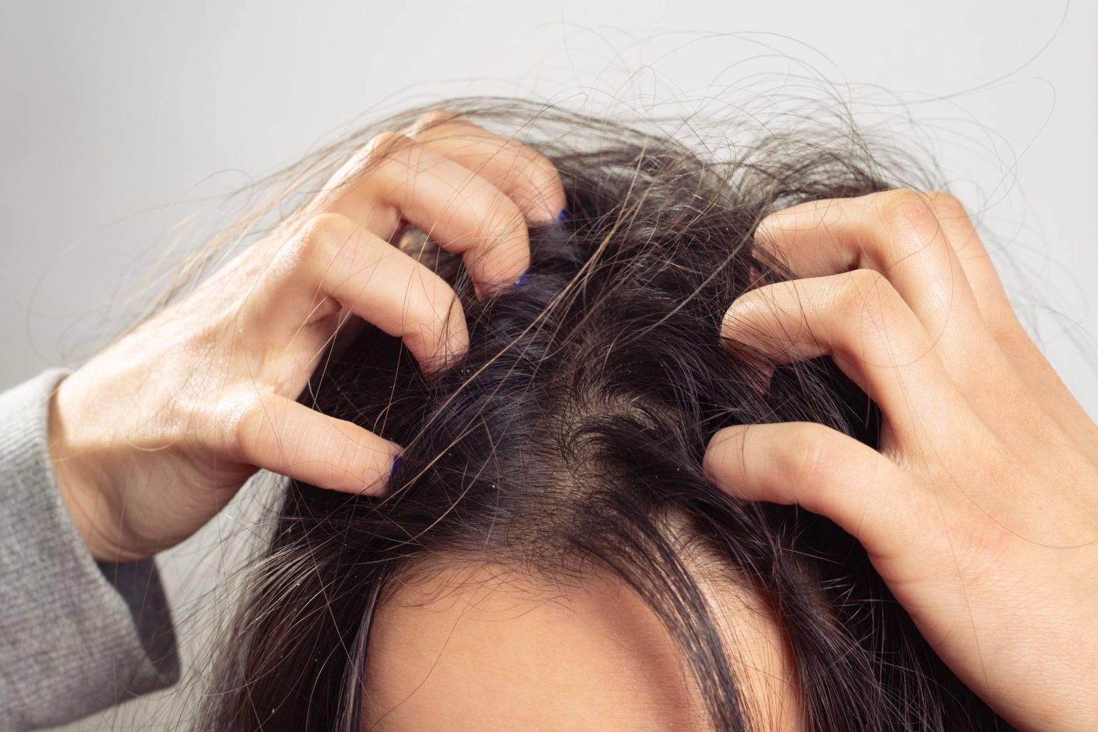hair dandruff causing itching and scratching